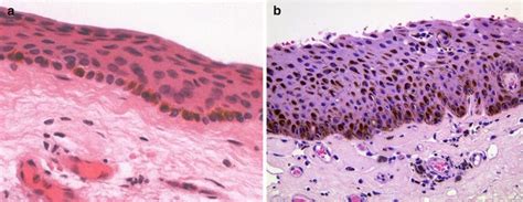 Conjunctival and Corneal Tumors: Primary Acquired Melanosis | Ento Key