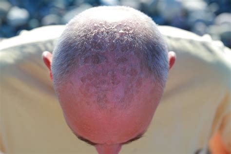 Dry Flaky Skin on Your Bald Head: Prevention & Treatment - Shaving Advisor (2024)