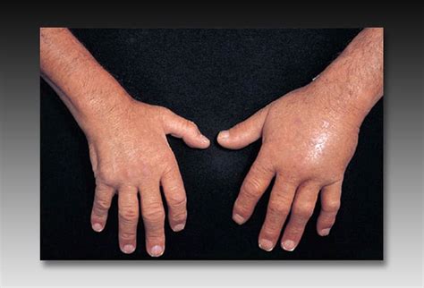 Notable Knuckles, Part 2: Evaluating More Conditions of the Hand