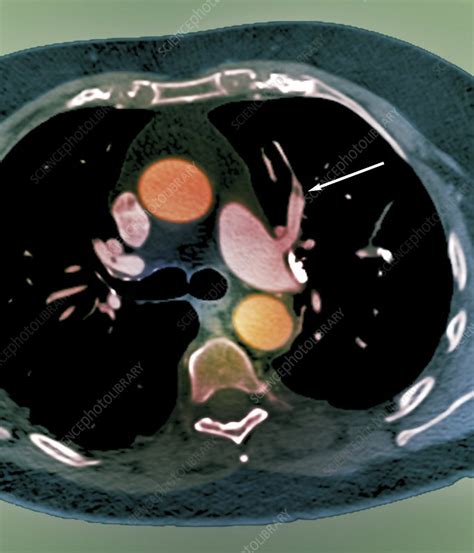 Pulmonary embolism, CT scan - Stock Image - C010/4916 - Science Photo Library