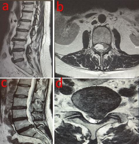 Non-contrast MRI of patient with lumbar disc herniation superiorly ...