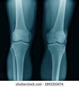 Oa Knee Xray Image Posteoanterior View Stock Photo 1892203474 ...