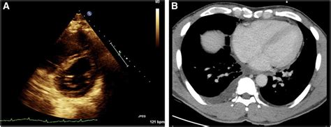 Case 2: (A) Echocardiogram exhibiting "D sign" of the interventricular ...