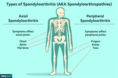 Axial Spondyloarthritis vs. Ankylosing Spondylitis: What's the Difference?