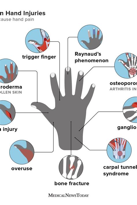 Hand pain: Causes, home remedies, and treatments