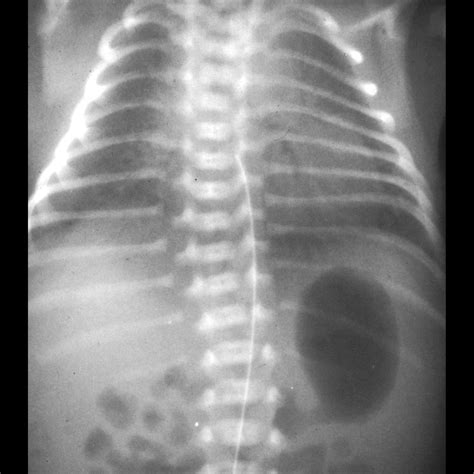 Pulmonary Hypoplasia | Pediatric Radiology Reference Article | Pediatric Imaging | @pedsimaging