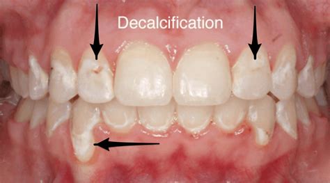 What Is Decalcification Of Teeth? - ArchWired