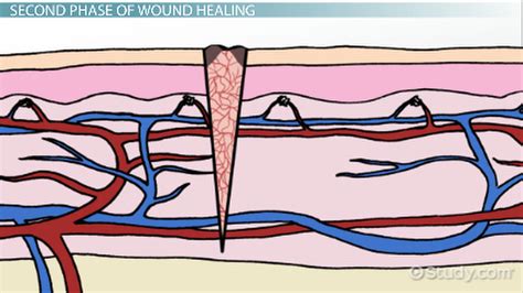 Stages of Wound Healing | Overview, Process & Timeline - Lesson | Study.com