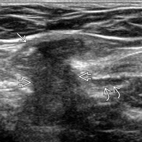 Inguinal Groin Hernia