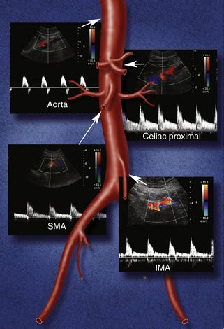 Mesenteric Ischemia Ultrasound