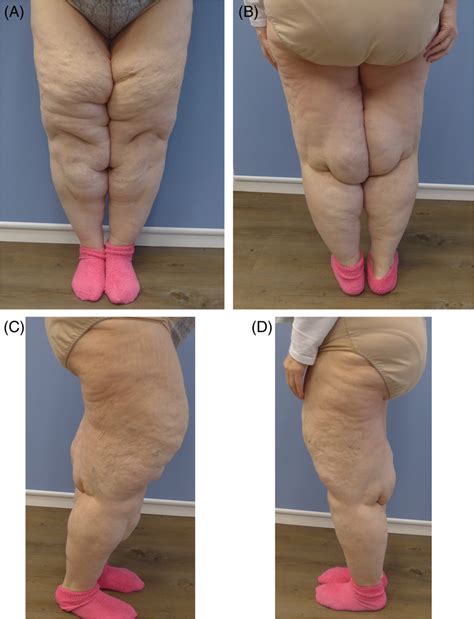 A‐D, Preoperative view of a 43‐year‐old female patient with lipoedema... | Download Scientific ...