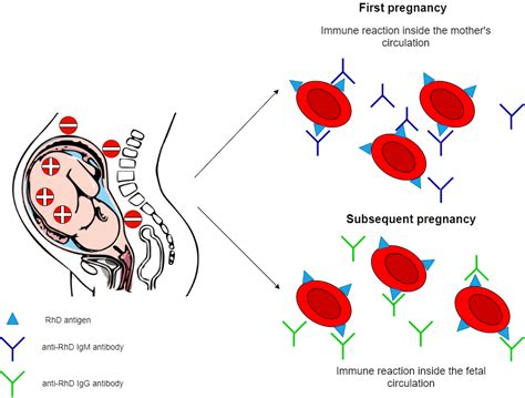 Hemolytic disease of the newborn - Simplebiol