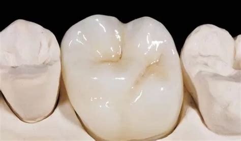 Advantages and Disadvantages of Zirconia Crown | AVF Dental Group