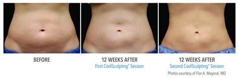 CoolSculpting Abdomen / Stomach Before and After Photos NYC