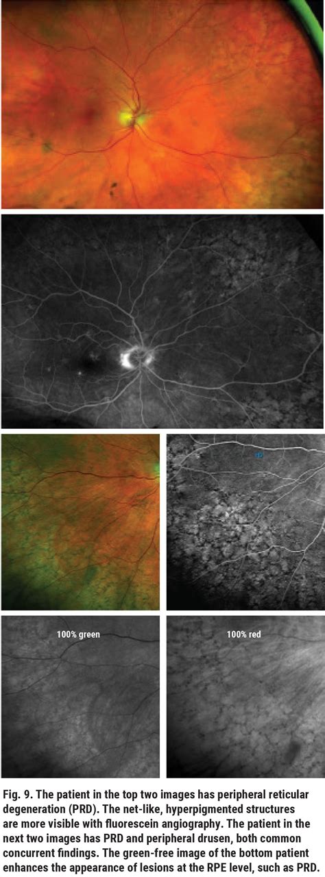 Navigating the Retinal Periphery