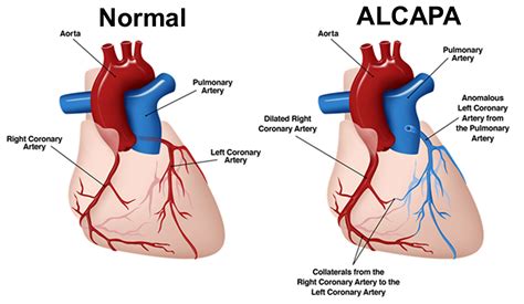 ALCAPA, anomalous left coronary artery, causes, symptoms, diagnosis ...