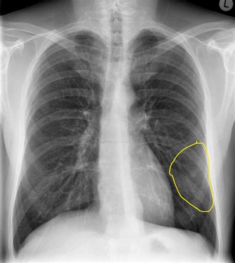 Mycoplasma pneumonia differential diagnosis - wikidoc