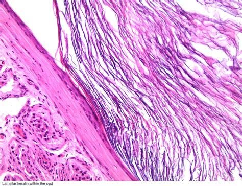 Pathology Outlines - Epidermoid cyst