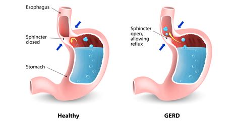 Antireflux Surgery (GERD) | Mithani MD