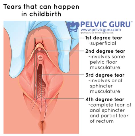 Figure From Third Degree Perineal Lacerations-How, Why And, 51% OFF