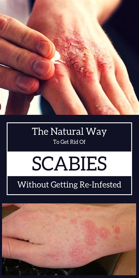 Scabies Rash On Arms