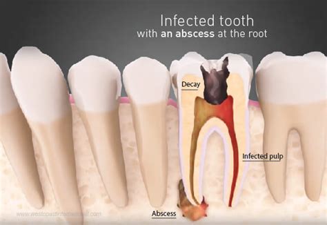 Dental Cysts: What Are They and How They Can Be Prevented?