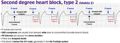 Rosh Review | Heart blocks, Medical school stuff, Medical laboratory ...