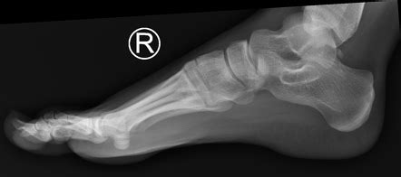 Foot (lateral view) | Radiology Reference Article | Radiopaedia.org