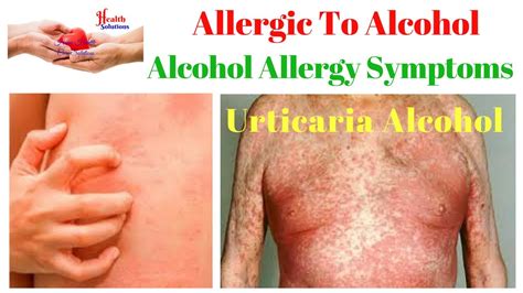 Allergic To Alcohol - Urticaria Alcohol - Alcohol allergy Rash☺ - YouTube