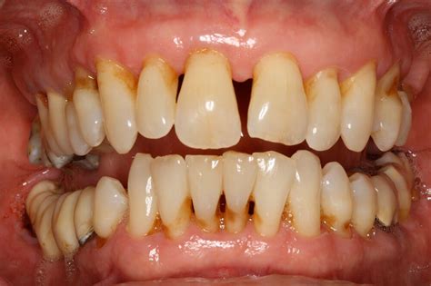 Periodontal Disease – Britten Perio