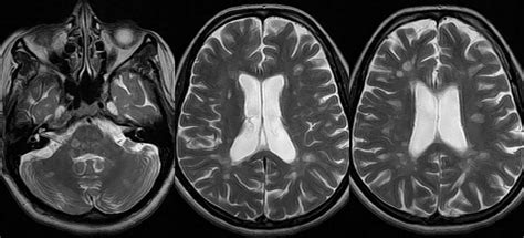 Dr Balaji Anvekar FRCR: Multiple Sclerosis MRI