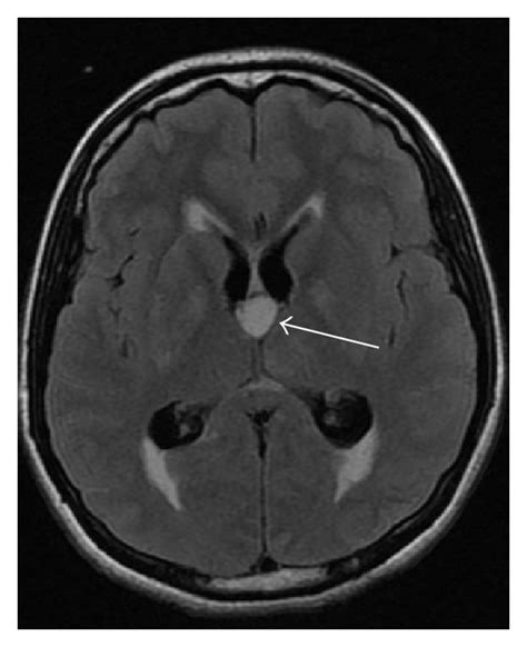 Segmentation: Third Ventricle And Transverse Cerebral, 40% OFF