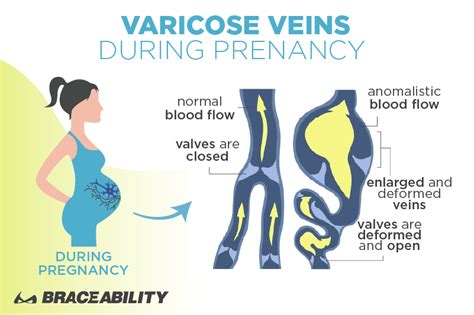 #1 Vulvar Varicosities Guide: What are Pelvic Varicose Veins?