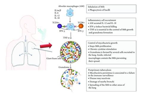 Pathogenesis Of Tuberculosis Tb Pathogenesis Can Be Divided In Four | My XXX Hot Girl