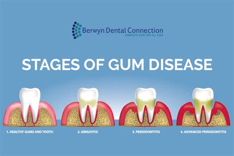 Stages of Gum Disease to know if you are facing gum related problems.