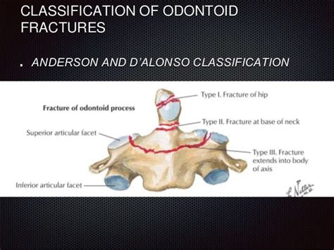 Non union of odontoid fractures