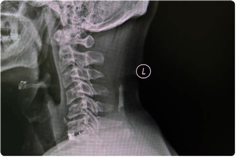 Spondylosis Cervical Spine X Ray