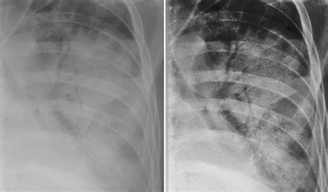 Air bronchograms - Radiology at St. Vincent's University Hospital