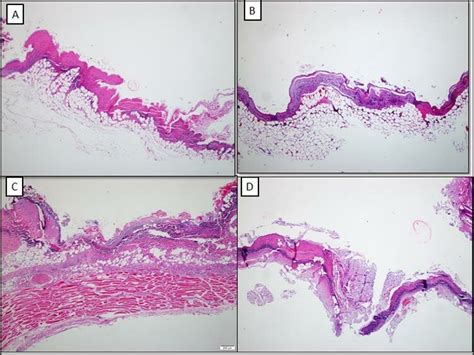 Skin ulcers characterized by necrotic debris and inflammatory... | Download Scientific Diagram