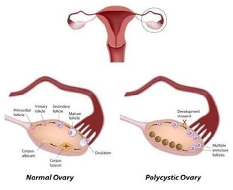 Polycystic Ovary Syndrome (PCOS): Symptoms, Complications, and Treatment