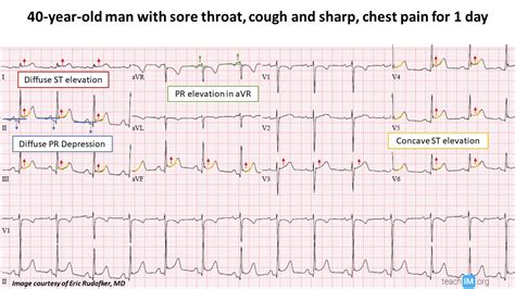 Pericarditis | ECG | teachIM