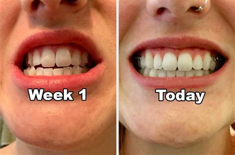 I've Had Invisalign For Two Years And Here's Everything I've Learned | Invisalign, Natural teeth ...