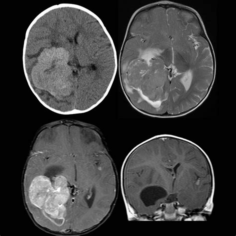 Pediatric Choroid Plexus Carcinoma | Pediatric Radiology Reference Article | Pediatric Imaging ...