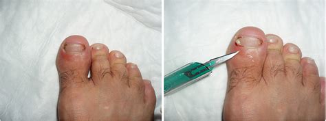 Big Toe Nail Bed Infection - Nail Ftempo