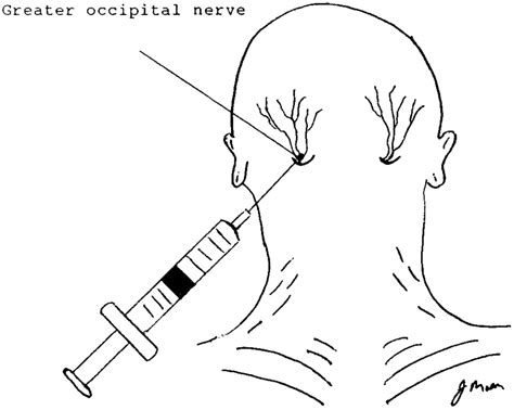 Anatomy and technique of occipital nerve block for treatment of... | Download Scientific Diagram