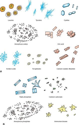 Urine Sediment Crystals Flashcards | Quizlet