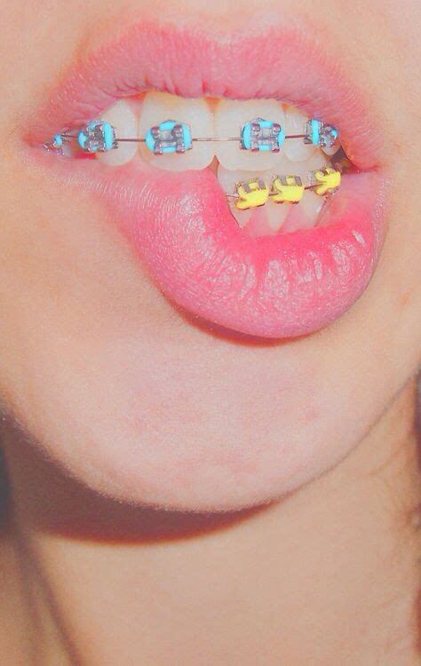 and I wish I had this braces before | Braces colors, Cute braces, Braces tips