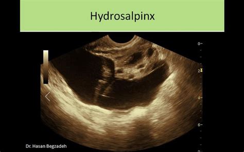 hydrosalpinx | Ultrasound sonography, Sonography, Ultrasound