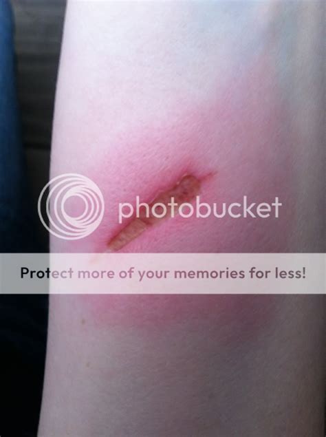 Burn help... Is this infected? Pics included | BabyCenter