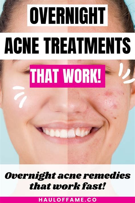 Top 5 best overnight acne spot treatments – Artofit